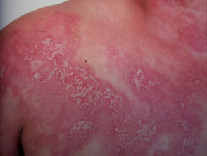 Dermatosi pustolosa subcorneale