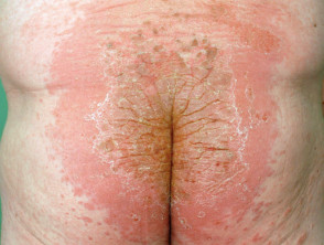 Alergia al dimetilfumarato: dermatitis de sofá