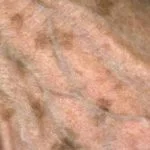 solar-lentigo-01__protectwyjqcm90zwn0il0_focusfillwzi5ncwymjisinkildm2xq-2402077-5709873-jpg-2883512