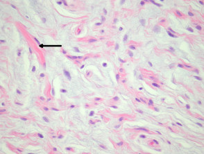 Patología del lipoma de células fusiformes