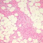 spindle-cell-lipoma-figure-1__protectwyjqcm90zwn0il0_focusfillwzi5ncwymjisingildfd-9017483-6456558-jpg-6148950