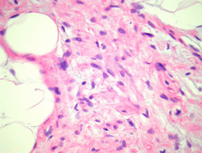 Patología del lipoma de células fusiformes