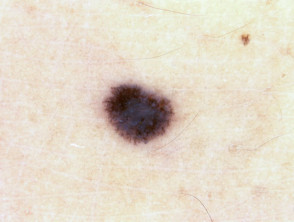Nevus pigmentado de Spitz, tipo de piel 1, dermatoscopia