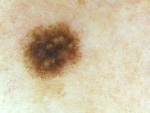 Dermatoscopia de Spitz nevus (pigmentada)