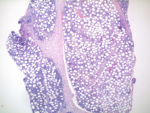 Pathologie des subkutanen T-Zell-Lymphoms vom Panniculitis-Typ