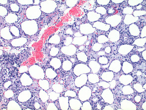 Pathologie des subkutanen T-Zell-Lymphoms vom Panniculitis-Typ