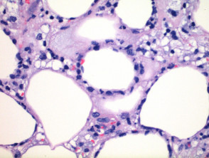 Patología del linfoma de células T tipo paniculitis subcutánea