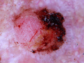 Dermatoscopia de carcinoma de células escamosas pobremente diferenciado