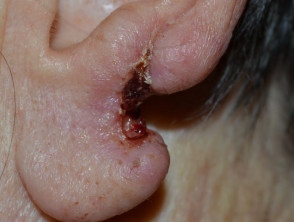 Lóbulo de la oreja izquierda