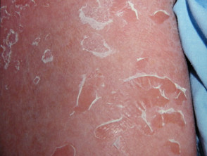 Síndrome de piel escaldada por estafilococos