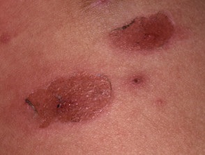 Síndrome de piel escaldada por estafilococos