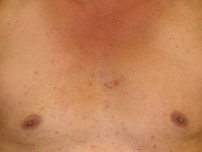 steroïde acne