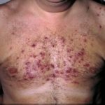 steroid-acne__protectwyjqcm90zwn0il0_focusfillwzi5ncwymjisingildeyxq-3291790-1813962-jpg-9134337