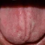 stomatitis1__protectwyjqcm90zwn0il0_focusfillwzi5ncwymjisingildfd-3872778-2675739-jpg-1772369