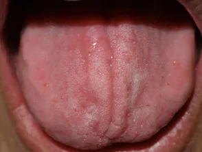 contactstomatitis