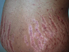 striae (striae)