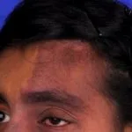 sturge-weber-01__protectwyjqcm90zwn0il0_focusfillwzi5ncwymjisingildbd-4311995-5882312-jpg-8612058