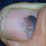 subungual-haematoma-2-v3__protectwyjqcm90zwn0il0_focusfillwzi5ncwymjisingildfd-4861436-5506668-jpg-8510808