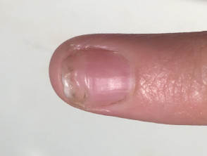 Recuperación de uñas después de un trauma