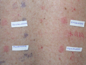 Alergia a oxibenzona y mexenona en la prueba de parche con fotoagravación