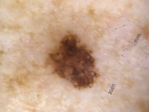 Dermatoscopia de melanoma de extensión superficial 
