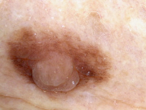 Überzählige Dermoskopie der Brustwarze