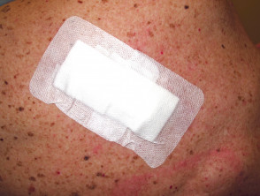 Cirugía de piel para melanoma