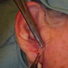 Sutura de la herida quirúrgica después de la extirpación del melanoma