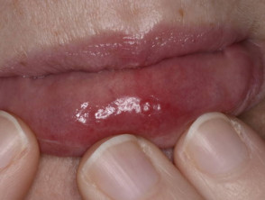 Síndrome de Sweet que afecta el labio