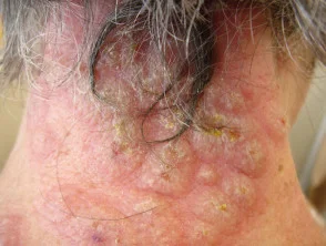 Dermatosi neutrofila acuta