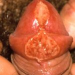 syphilis-18__protectwyjqcm90zwn0il0_focusfillwzi5ncwymjisinkildewnv0-9520617-5999507-jpg-9130673