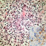 syphilis-figure-1__protectwyjqcm90zwn0il0_focusfillwzi5ncwymjisingildfd-9003655-1835021-jpg-7356737
