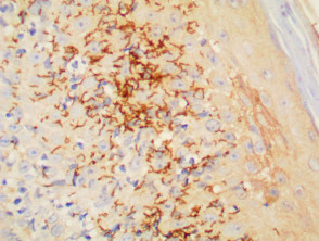 Patología de la sífilis con organismos mostrada por la tinción inmunohistoquímica de Treponema pallidum x400