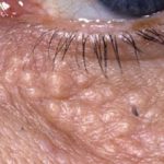 syringoma1__protectwyjqcm90zwn0il0_focusfillwzi5ncwymjisinkildm2xq-6867750-1479922-jpg-2575824