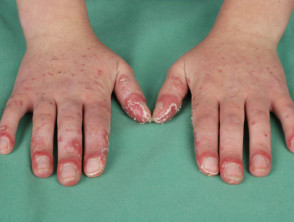 Lupus eritematoso sistémico de los dedos
