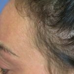 telogen-effluvium-regrowth__protectwyjqcm90zwn0il0_focusfillwzi5ncwymjisingildfd-9933518-8600536-jpg-2903978