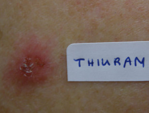 Positieve patch-test voor thiuram