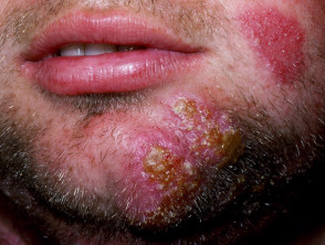 Infección por hongos en la barba