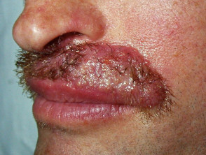 Infección por hongos en la barba