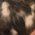 tinea-capitis-001__protectwyjqcm90zwn0il0_focusfillwzi5ncwymjisingildfd-4522242-5424393-jpg-1163455