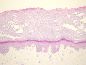Patologia di tinea nigra