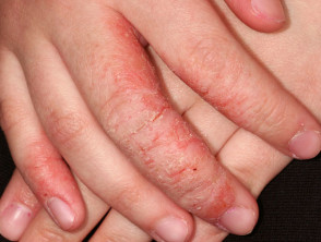 Dermatitis irritante atópica de las manos