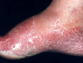 tinea pedis