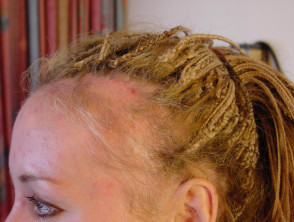 Alopecia por tracción