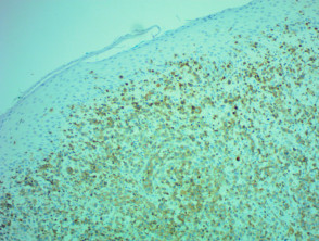Patología de micosis fungoide transformada teñida con CD3 x100