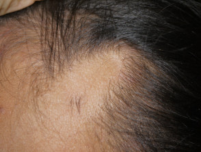 Alopecia temporal triangular