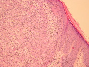 Patología del carcinoma trichilemmal