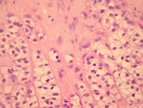 Patología del carcinoma trichilemmal