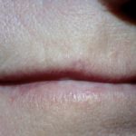 trichilemmoma__protectwyjqcm90zwn0il0_focusfillwzi5ncwymjisingildfd-4327662-2477930-jpg-5177507