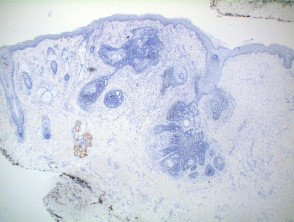 Patología del tricoepitelioma, tinción Ber-EP4